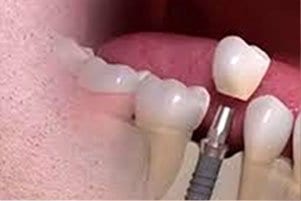 Dental Implant