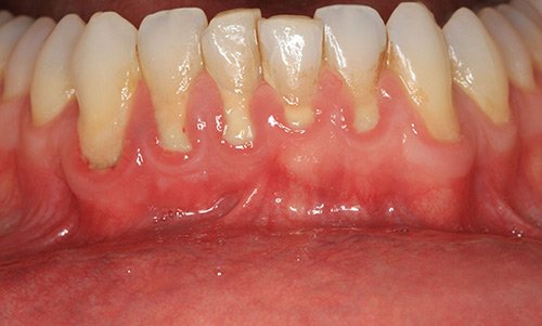 Receding gums from periodontal disease 