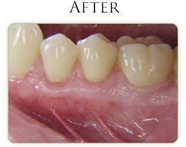 Gum Graft After