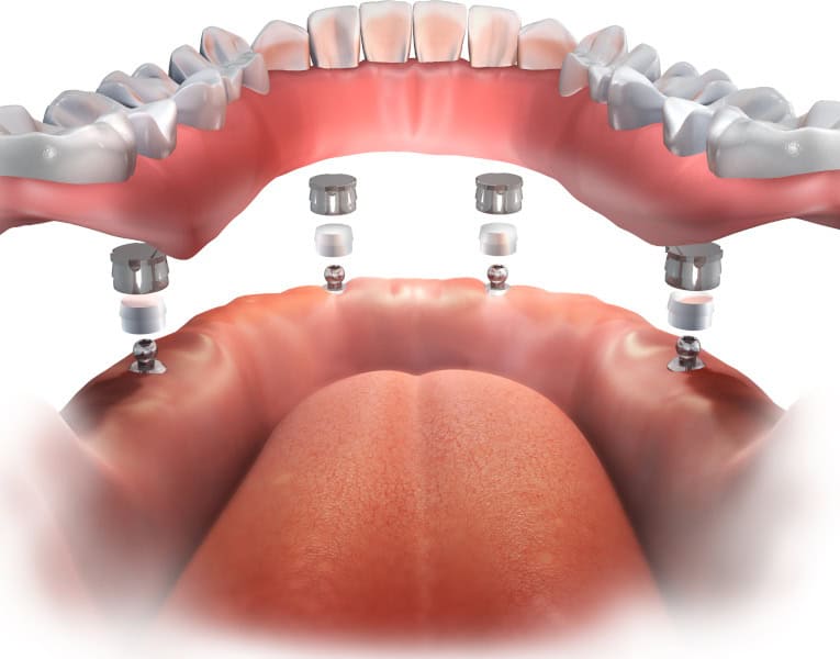 2. Simplified surgery