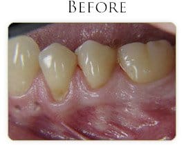 Gum Graft Before