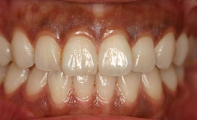 Dark Gums Before Treatment