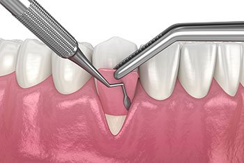 Gum Grafting Diagram