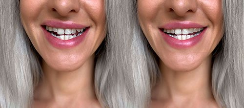 Invisalign Before and After