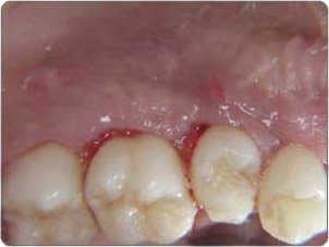 Periodontal Disease