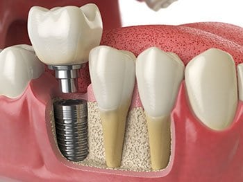 Titanium implant in jaw alongside natural teeth