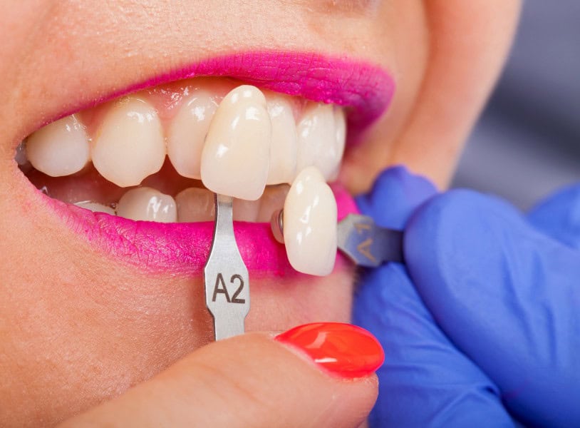 How long do veneers last?