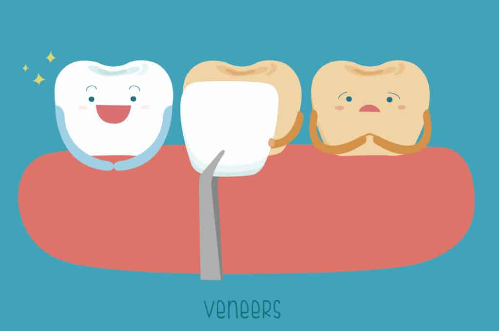 Veneers Illustration