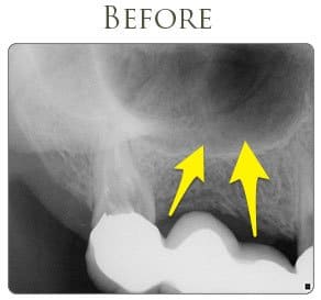 Sinus Graft Before