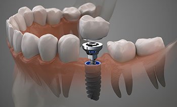 Dental implant post, abutment, and crown in jaw