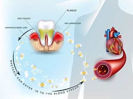 Invisalign vs Braces - Century Smile Dental - Culver City