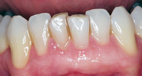 Gum Graft Before and After Pictures | MD Periodontics Los Angeles