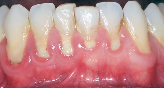 Gum Graft Before and After Pictures | MD Periodontics Los Angeles