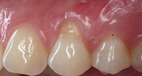 Gum Graft Before and After Pictures | MD Periodontics Los Angeles