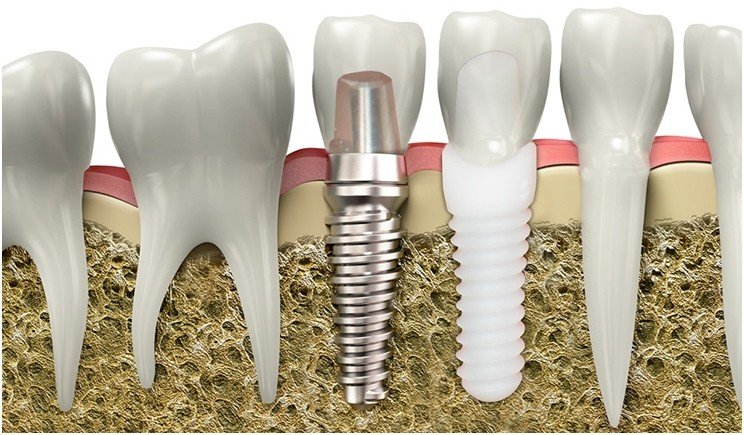 Ceramic zirconia dental implant model showing the metal free implant post and crown