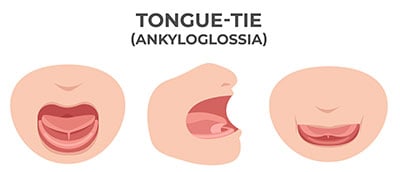 Illustration of tongue-tie. Text reads: Tongue-tie (Ankyloglossia)