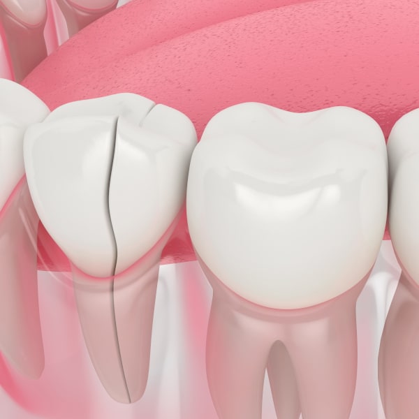 Isolated deep pocket associated with vertical root fracture and