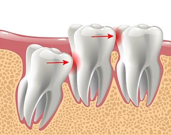 Illustration of impacted wisdom tooth