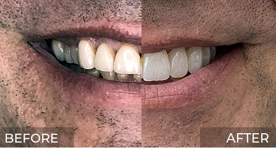 Full Mouth Restoration Before & After