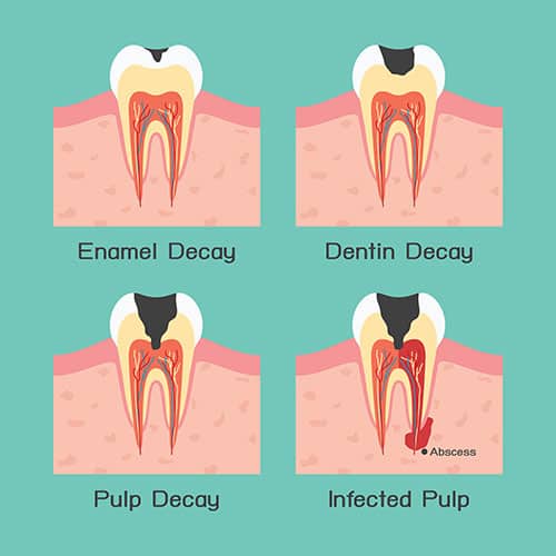 Signs Of Tooth Enamel Erosion And Why Its Important Md Periodontics 0769