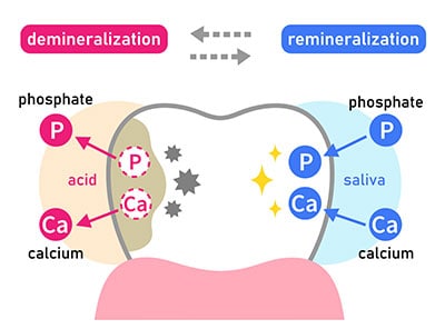 Diagram of tooth enamel erosion and remineralization