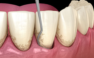 Image of tooth scaling