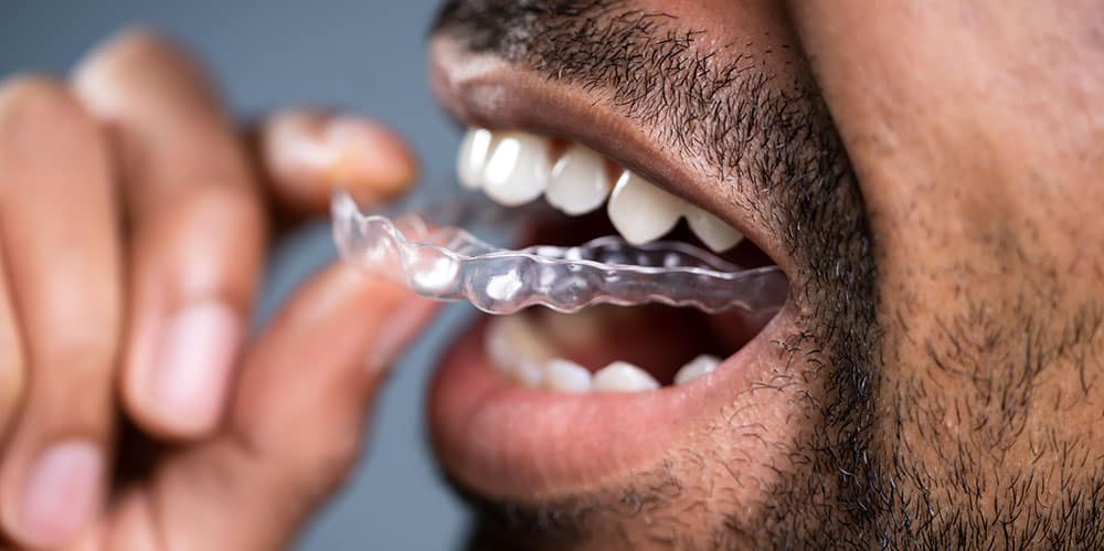 The benefits of space maintainers and clear braces in preventing