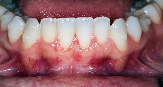 Gum Graft Before and After Pictures | MD Periodontics Los Angeles