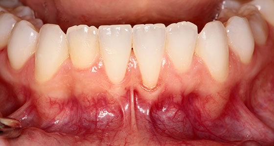 Gum Graft - Before