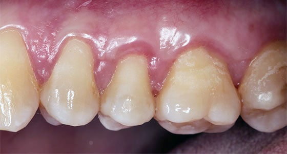 Gum Graft - After