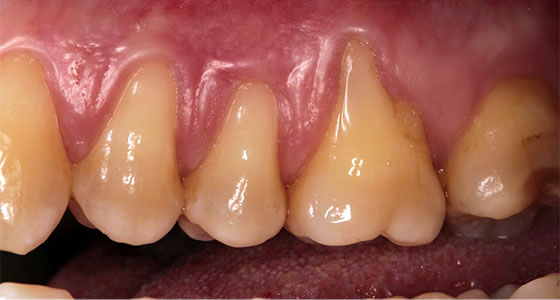 Gum Graft - Before