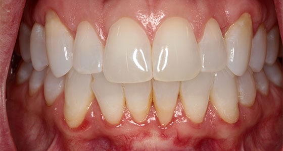 Gum contouring and gum grafts: before and after transformation