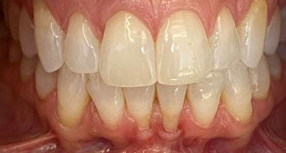 Gum Graft - Before