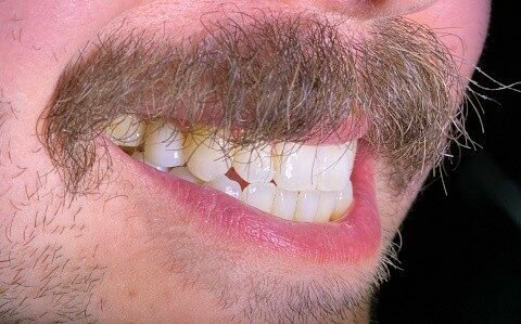 Dental Implant After