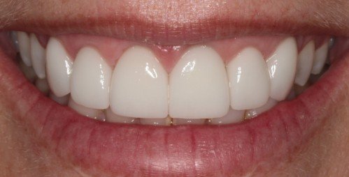 Crown Lengthening for Gummy Smiles After