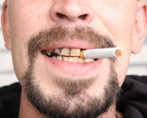 Man with yellow teeth and a cigarette in his mouth