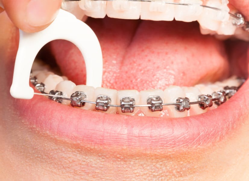 How important is flossing with braces?