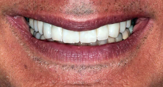 Full-mouth rehabilitation