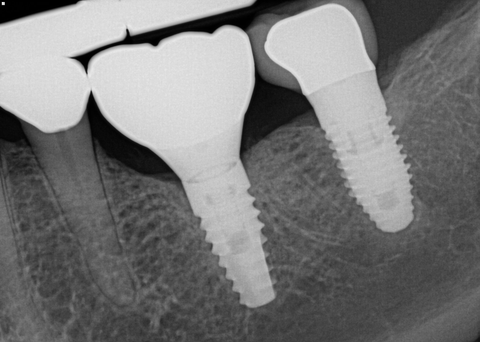 Occlusal view comparing a screw-retained implant crown with a sealed access channel next to a cement-retained implant crown, Beverly Hills