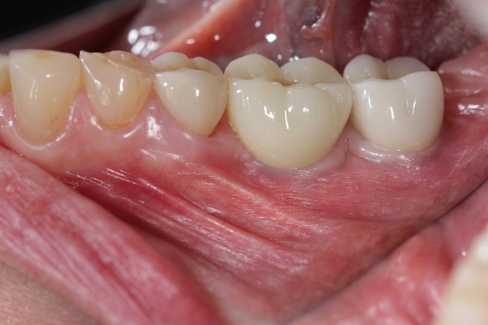 Screw-retained and cemented dental implant crowns restored side by side in the lower left quadrant at MD Periodontics in Beverly Hills