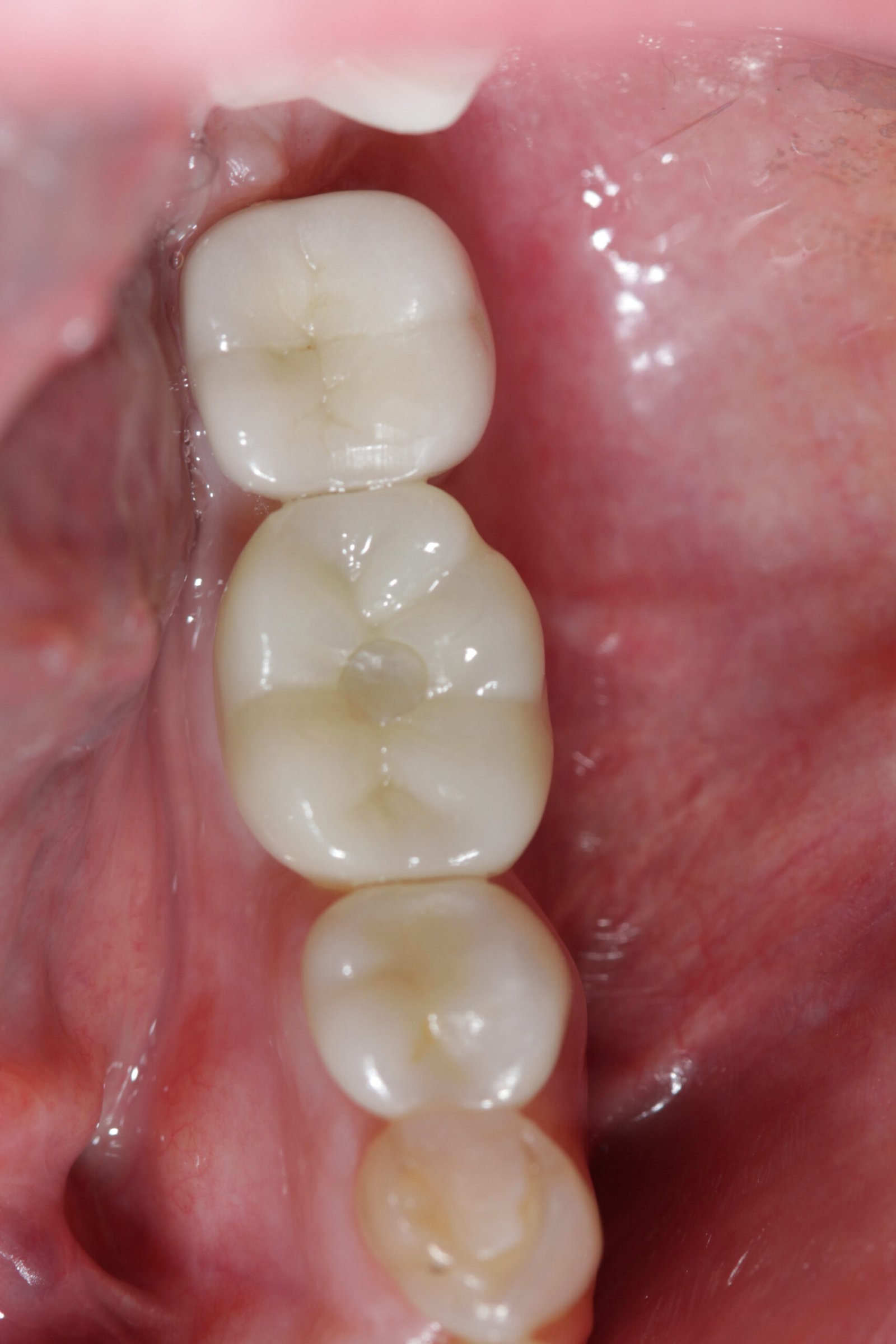 Dental X-ray showing a screw-retained implant crown seated on a dental implant in the lower jaw, Beverly Hills periodontist case